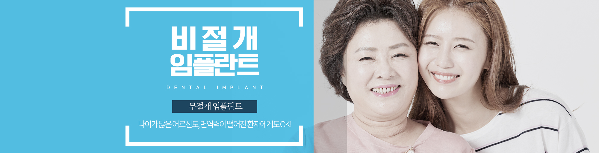 비절개 임플란트 안내 - 다산리더스치과의원